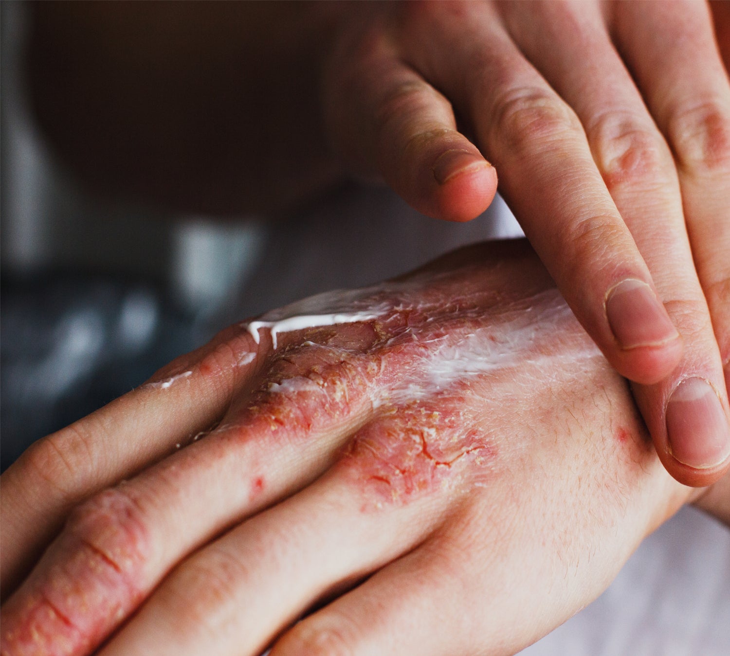 Man applying cream to eczema on hands