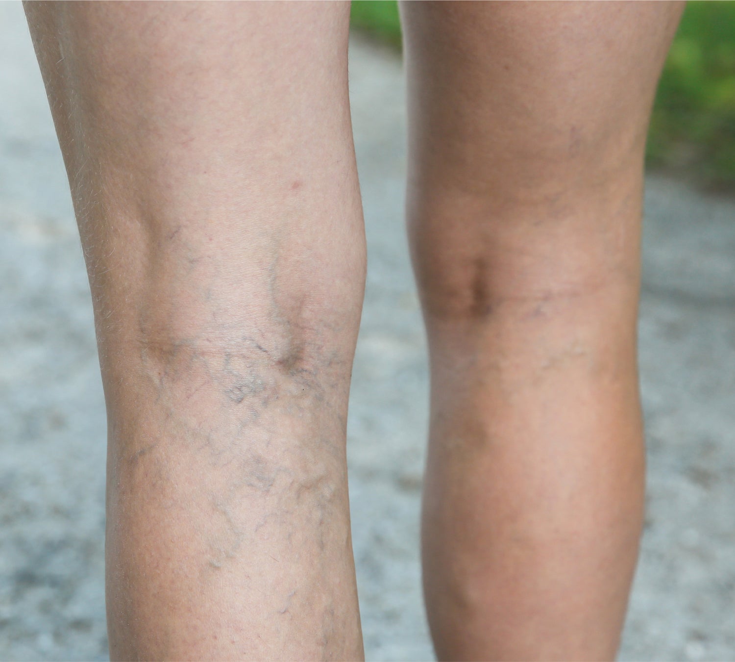 Varicose veins on back of legs